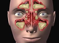 썸네일-코 풀어도 풀어도 콧물이 계속 나오는 이유.jpg-이미지