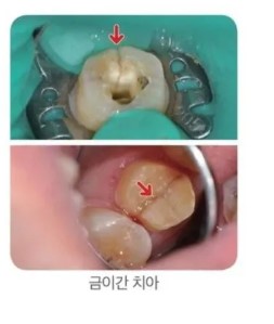 nokbeon.net-치과의사들이 진짜로 먹지 말라는 거.jpg-2번 이미지